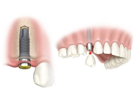dental implants boise ID