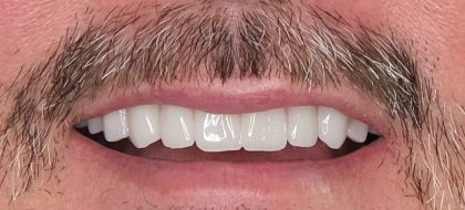 Close up of teeth