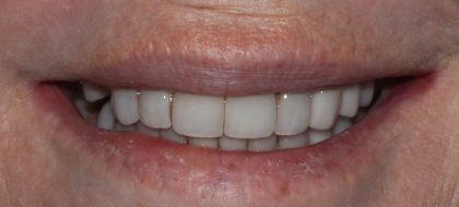 Close up of teeth