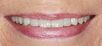 Close up of teeth