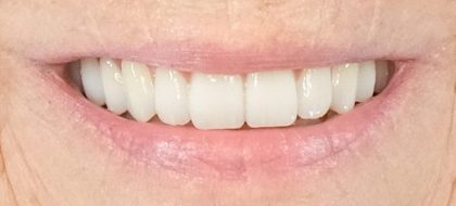 Close up of teeth