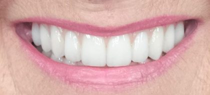 Close up of teeth
