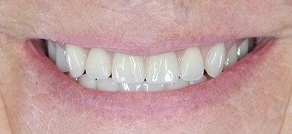 Close up of teeth
