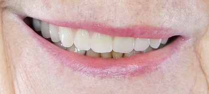 Close up of teeth