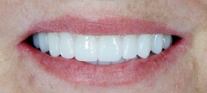 Close up of teeth
