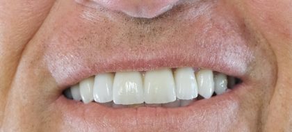 Close up of teeth