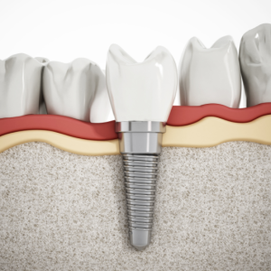 dental implants in Boise Idaho